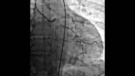 Angiography-of-heart-vessels