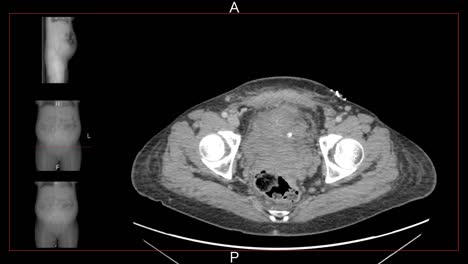 Berechnete-axiale-Tomographie-(CAT)-Scan-einer-Frau-Bauch-und-Becken