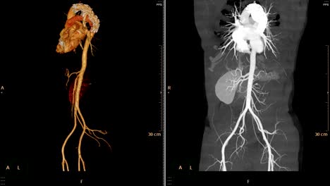 Aorta-abdominal-CTA.