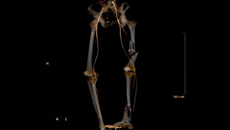 Arteria-femoral-CTA-escurr.