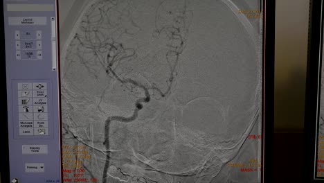 The-monitor-shows-the-patient's-condition-during-an-operation-on-the-brain.