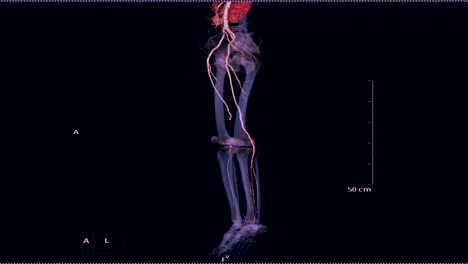 CTA-femoral-artery-run-off-3D-rendering-image.