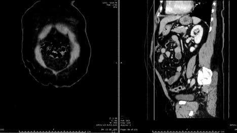 CT-Scan-/-CTA-Bauchaorta.-Medizintechnik-Konzept.