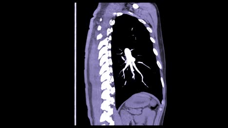 CTA-del-pecho-mostrando-la-embolia-pulmonar-(flecha-blanca).