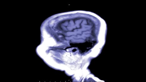 MRI-of-the-brain-in-sagittal--plane-with-contrast-media-.magnetic-resonance-imaging-of-the-brain.