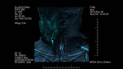 Medical-monitor-with-Brain-vessels-angiogram-|-Cerebral-angiography.