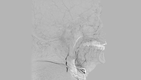 Grau-gefärbt-zerebralen-Angiogramm.-Gehirn-Schiffe-Angiographie.