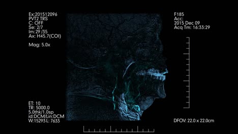 Medical-monitor.-Side-view-of-cerebral-angiogram.