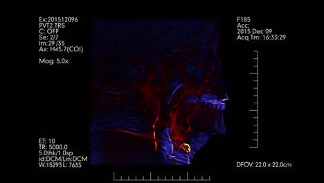 Monitor-médico-de-azul-y-naranja.-Vista-lateral-de-la-angiografía-cerebral