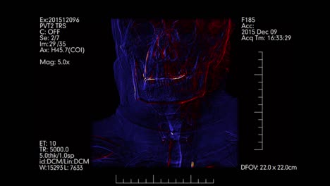 La-angiografía-de-vasos-cerebrales-|-Angiografía-Cerebral-de-color-azul-y-naranja.