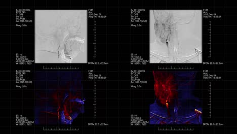 Medical-monitor-with-four-Brain-vessels-angiograms-on-it.