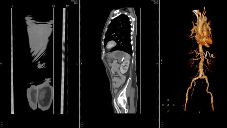 CTA-abdominal-aorta.