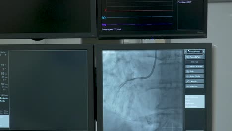 ECG-Monitore,-die-im-OP-Saal-stehen.-Sie-steuert-der-Chirurg-den-Zustand-des-Vorgangs.