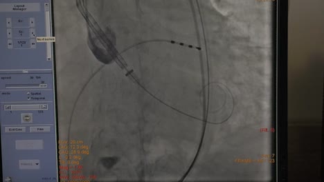 El-monitor-de-ECG-muestra-el-estado-del-paciente-durante-una-operación-de-corazón.