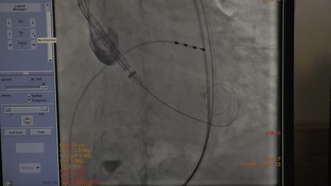 The-ECG-monitor-shows-the-patient's-condition-during-a-heart-operation.