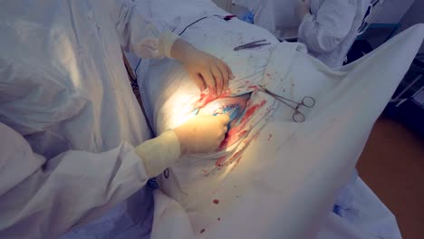 Surgeon-finishes-perfoming-surgery.-Doctor-disinfects-medical-suture.