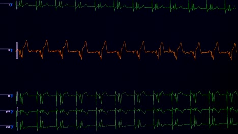 Lines-of-vital-rates,-heart-rate-being-shown-on-a-medical-screen