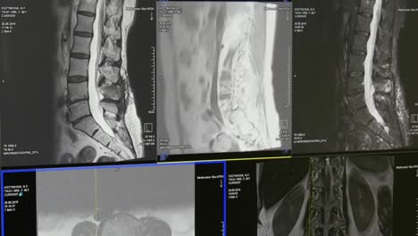 Médula-espinal-y-columna-vertebral-tomografía-de-resonancia-magnética.