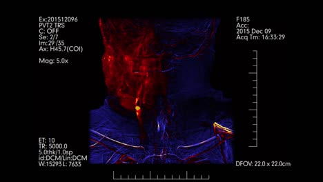 Medical-monitor-with-blue-and-orange-Brain-vessels-angiogram.