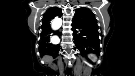 CTA)-der-thorakalen-Aorta-3D-Rendering-Bild.