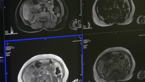 Tomografía-de-cerebro-en-MRI-exploración-equipo-médico-profesional.