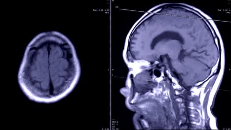 Resonancia-magnética-(MRI)-del-cerebro-en-Axial-y-sagital-con-contraste