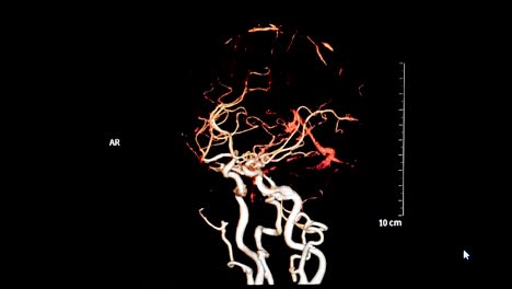 computed-tomography-angiography-or-CTA--of-the-brain-3D-Rendering-image--show-vessel-of-the-brain-rotating-on-the-screen.