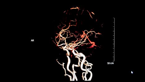 angiografía-por-tomografía-computada-o-CTA-de-la-imagen-de-renderizado-3D-de-cerebro-muestran-vasos-del-cerebro-girando-sobre-la-pantalla.