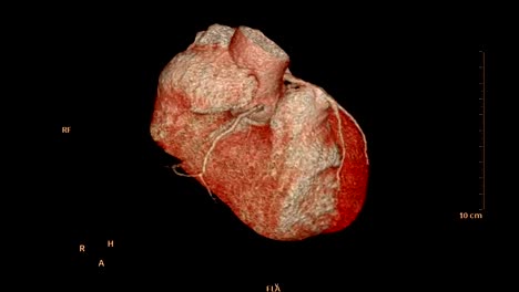 CTA-Coronary-artery--3D-rendering-image-of-the-realistic-heart-for-finding-heart-disease-.