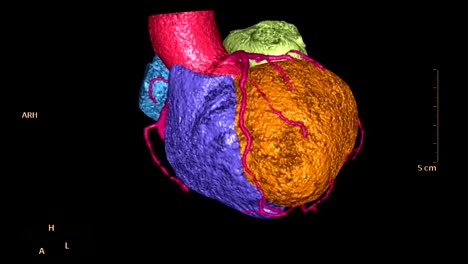 CTA-koronaren-Arterie-3D-Rendering-Bild-der-bunten-Herzen-für-die-Suche-nach-Herz-Kreislauferkrankungen.