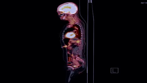 PET-CT-Bild-des-ganzen-Körpers-in-Sagittalebene.-Positronen-Emissions-Tomographie---Computertomographie.