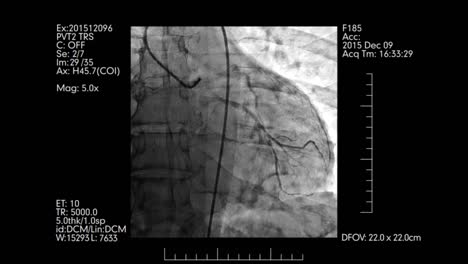 Coronary-angiography-monitor-|-Cardiovascular-angiogram