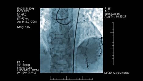 Angiographie-Prüfung-der-Herzgefäße-blau-gefärbt