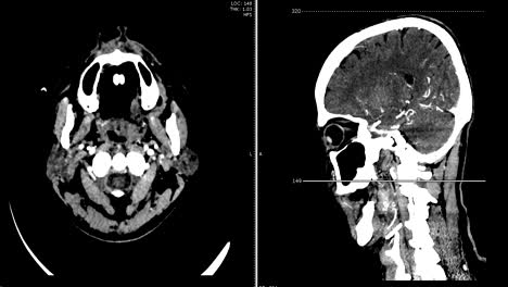 Computertomographie-Angiographie-des-Gehirns-mit-Kontrastmittel,-Axial-und-sagittaler-Ansicht,-3D-Rendering-Bild.