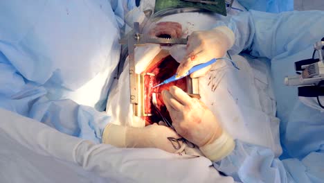 Vascular-procedure-is-being-carried-out-on-a-patient-with-cut-open-chest