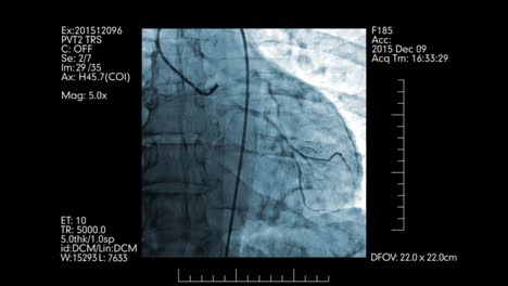 Digital-monitoring-of-heart-vessels-|-Cardiovascular-angiogram