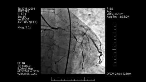 Angiografía-cardiovascular-prueba-de-pantalla-con-la-información-médica