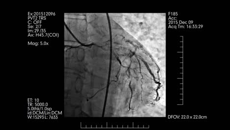 Cardiovascular-angiography-testing-display-with-medical-info