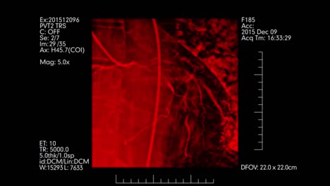 Red-colored-Heart-vessels-angiography-testing-display