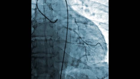 Medical-monitoring-of-heart-vessels-|-Cardiovascular-angiogram