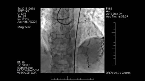 Angiography-testing-of-heart-vessels-monitor-with-medical-information