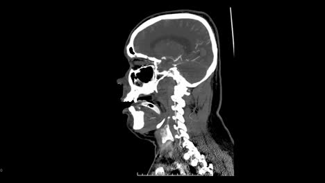 CT-Angiographie-an-Kopf-und-Hals.