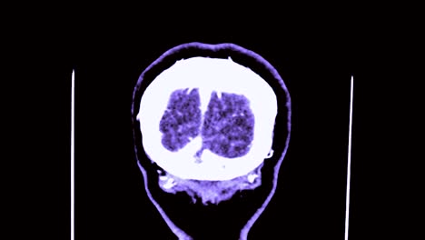 CTA-of-the-brain-3D-Rendering-image-in-coronal-plane.