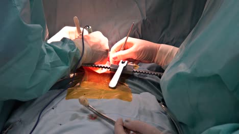 Cardiac-surgery.-Real-heart-beating-during-real-surgery.