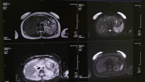 Tomografía-de-cerebro-en-la-exploración-de-MRI.