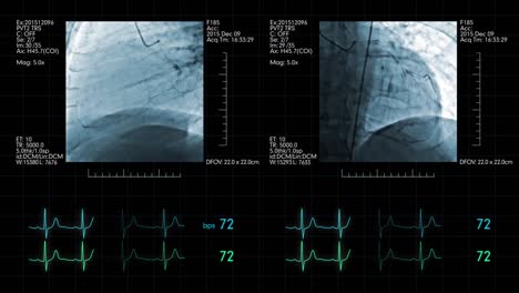 Angiografía-cardiovascular-con-pantalla-de-control-del-ritmo-cardiaco