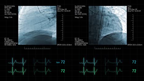 Cardiovascular-angiogram-with-heart-rate-monitoring-display