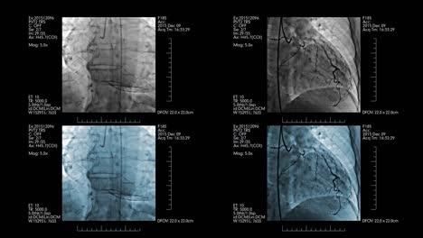Medical-display-with-four-coronary-angiograms-on-it