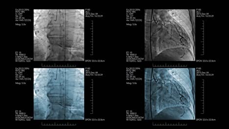 Visualización-médica-con-cuatro-angiogramas-coronarios-en-él