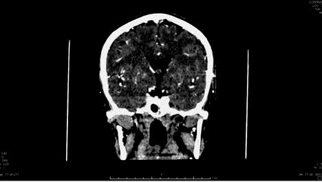 CT-Scan-des-Gehirns-mit-Kontrastmittel.